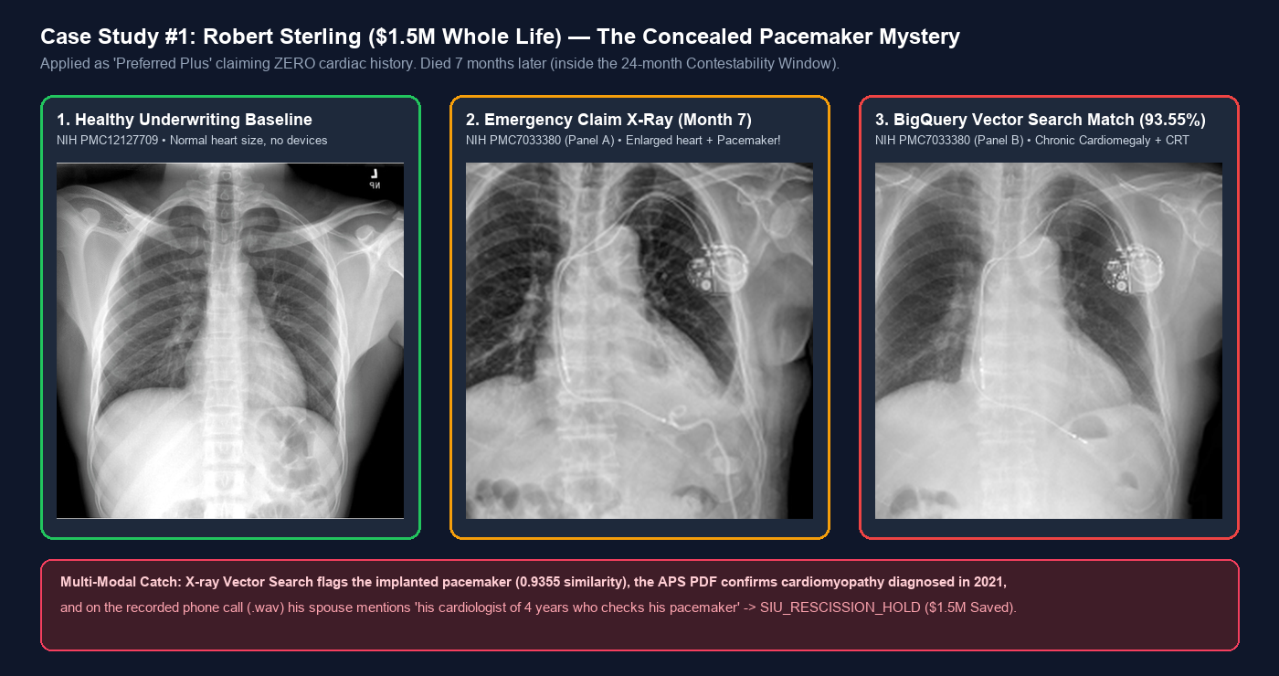 Case Study #1: Robert Sterling ($1.5M Whole Life) — The Concealed Pacemaker Mystery